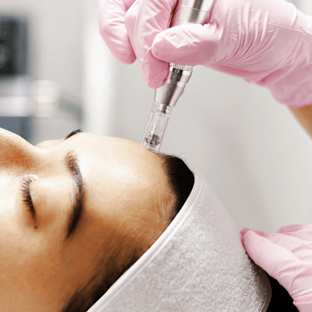 Microneedling Capilar
